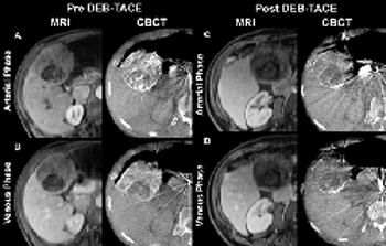 Image: Specialized DPCBCT scans of a liver tumor in a 73-year-old man before and after chemoembolization (second and fourth column from left) match up closely with MRI scans taken over a month later (first and third columns) (Photo courtesy of Johns Hopkins University).